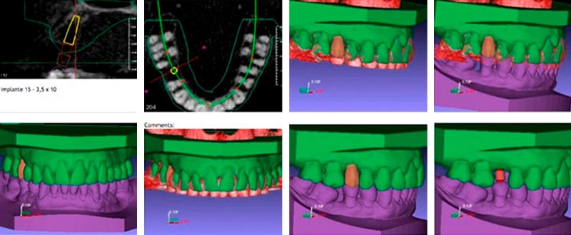 Implantes na posição planejada