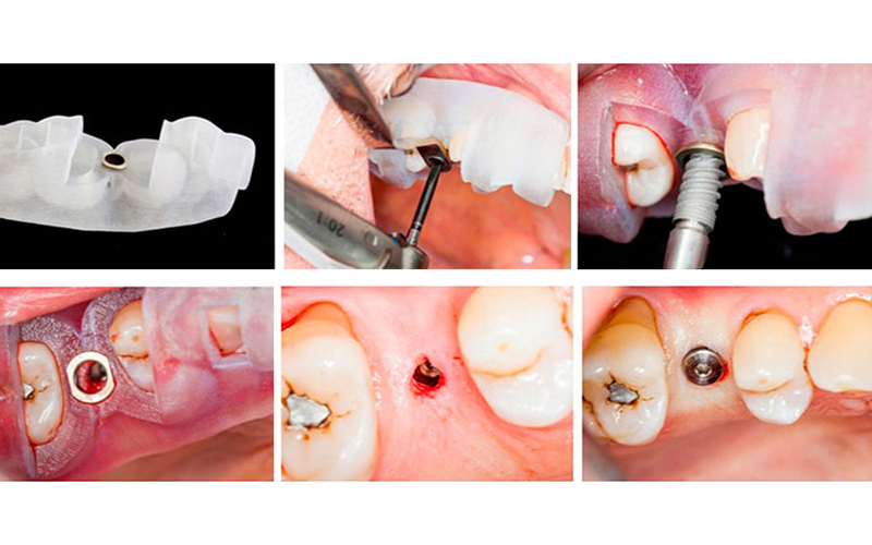 Terapia é indicada para desdentados totais e parciais